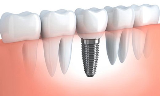 آموزش ایمپلنت جزء کریکولوم آموزشی دندانپزشکی قرار گیرد