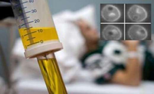 زنده ماندن ۷ الی ۱۵ درصدی بیماران مبتلا به سرطان مثانه با شیمی درمانی