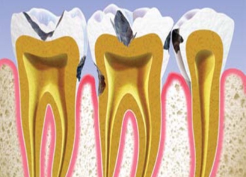 استرس احتمال پوسیدگی دندان را افزایش می‌دهد
