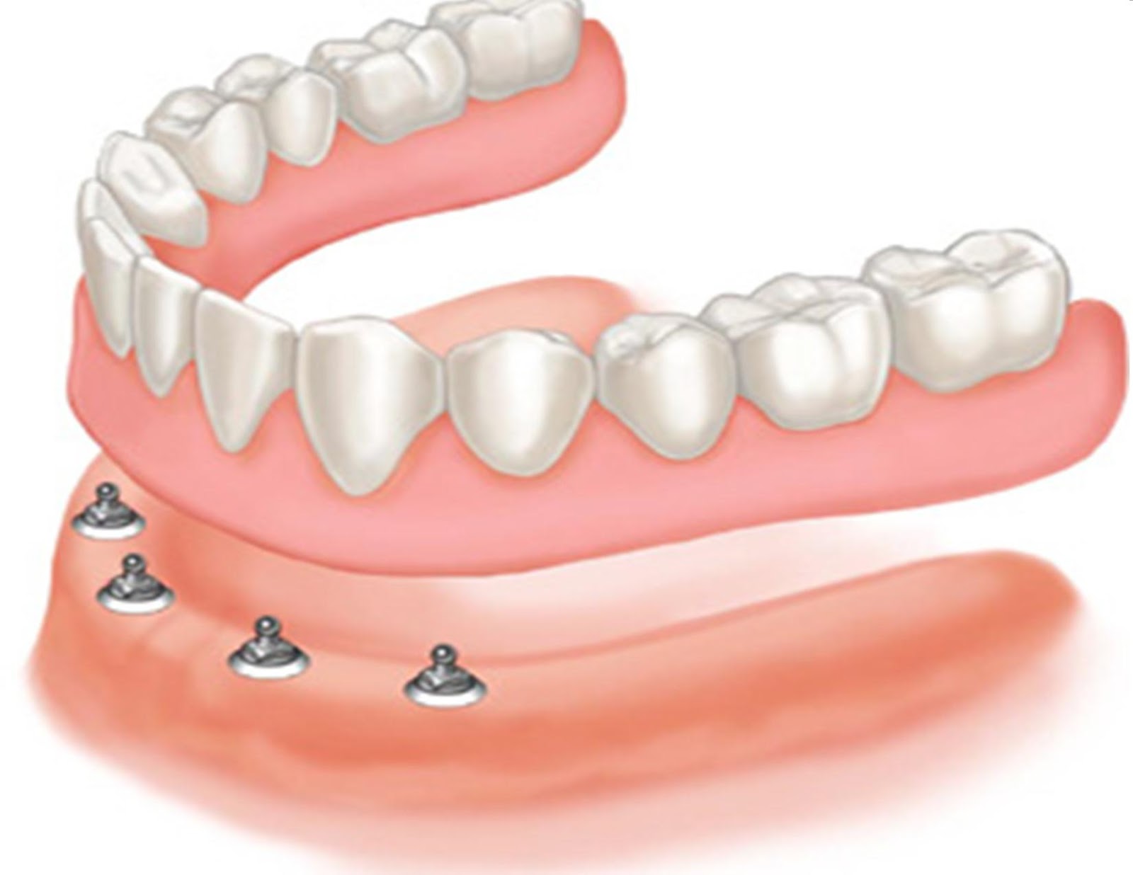 هر آنچه باید در مورد پروتزهای دندانی بدانید