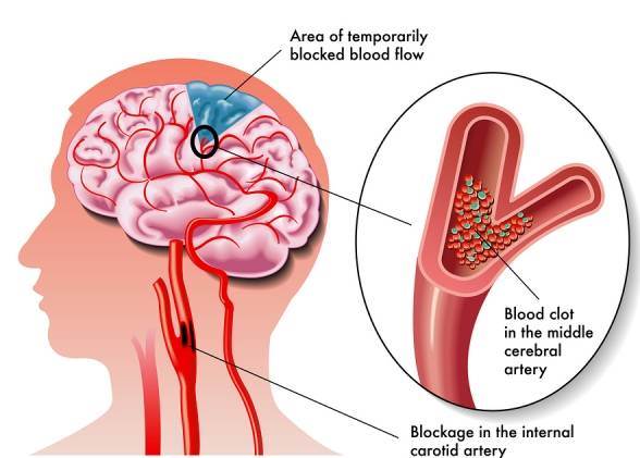 آمبولی مغزی ،شایع ترین علت سکته های مغزی است