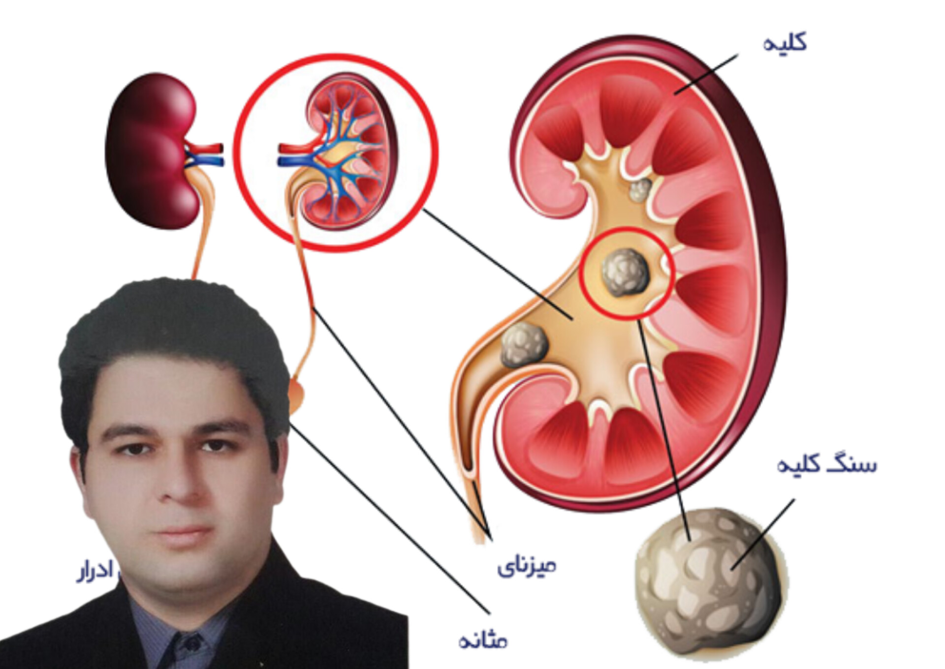 اختلالات متابولیک باعث ایجاد سنگ کلیه در کودکان خواهد شد